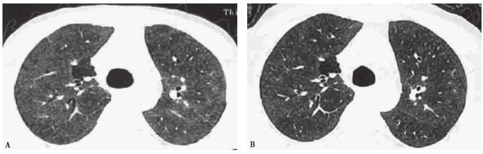 图8 亚急性过敏性肺炎胸部CT表现.jpg